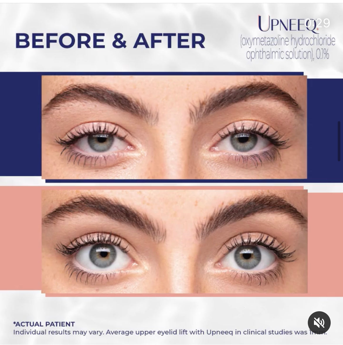 Upneeq - Innovative Eye Drops for Droopy Eyelids